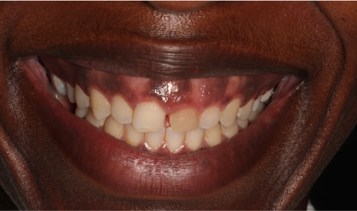 Patient initial smile presentation before composite bonding