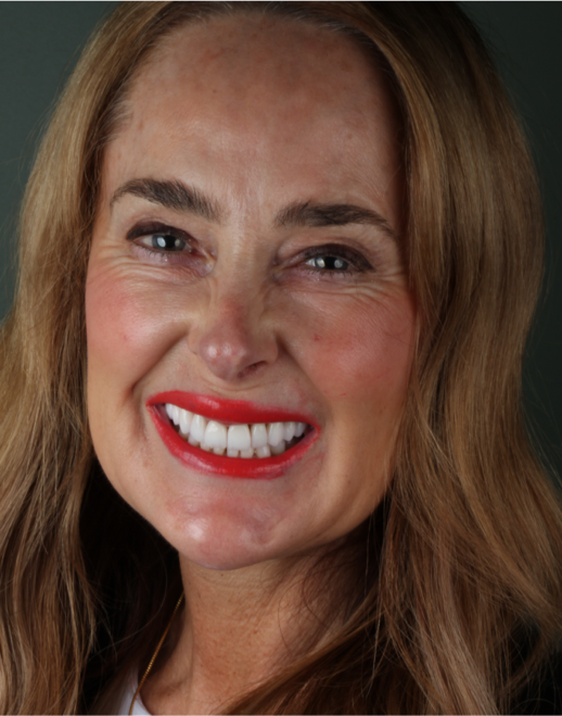 Patient Case Two: Full arch Invisalign alignment and ContactLensV veneers