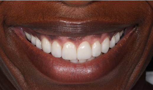 Patient completed smile transformation after composite bonding at Chelsea Dental Clinic