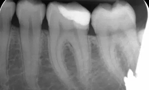Microscopic root canal treatment instrumentation