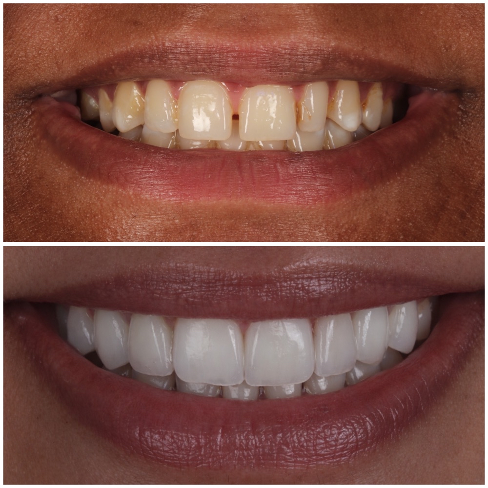 ContactLensV ultra-thin porcelain veneers closeup