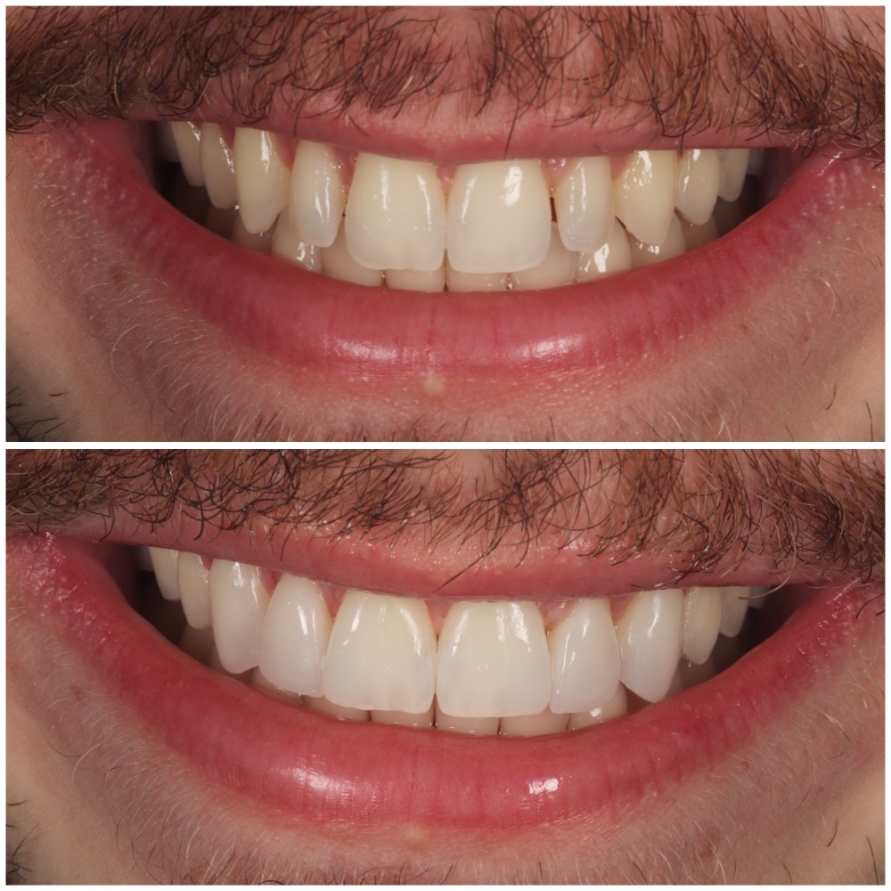 Patient Case Four: Smile makeover correcting worn teeth