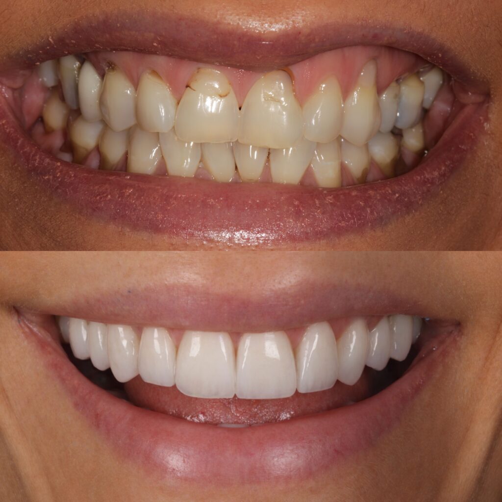 Handcrafted porcelain veneers result at Chelsea Dental Clinic