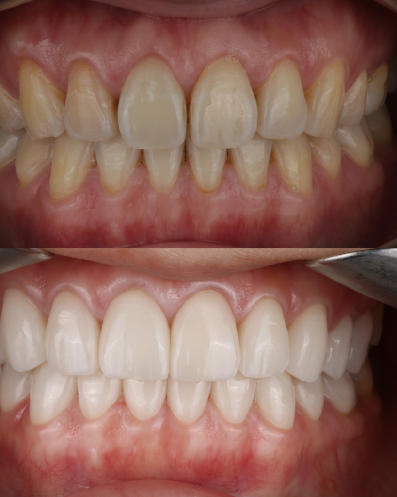Professional teeth whitening treatment result